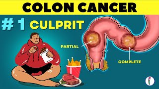 1 🔥 Cause of Colon Cancer amp how to prevent it  Colon Cancer  causes  Rectal cancer [upl. by Hayila]