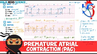 Rate and Rhythm  Premature Atrial Contraction PAC [upl. by Ailecec]