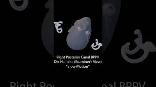 DixHallpike  Right Posterior Canal BPPV [upl. by Lipsey]