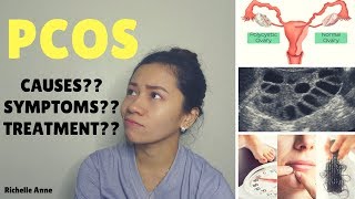 PCOS  Causes Symptoms Treatment  Tagalog [upl. by Retloc]