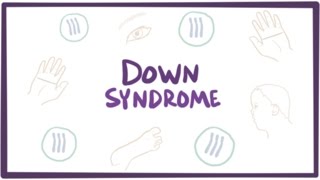 Down syndrome trisomy 21  causes symptoms diagnosis amp pathology [upl. by Tloh]