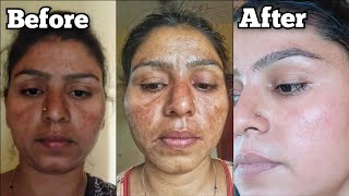 Pigmentation Khatam  Pigmentation Removing Bumper Remedy  Cooking with Sultana [upl. by Anastasio]