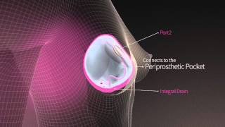 AlloX2 Tissue Expander for Breast Reconstruction [upl. by Anilegnave]