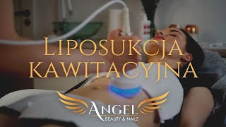 Liposukcja kawitacyjna – Liposukcja Bez Skalpela w salonach Angel Beauty amp Nails [upl. by Molton]