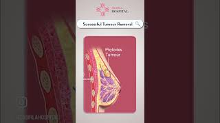 Massive Breast Phyllodes Tumor  Dr Rohan Khandelwal  Breast Cancer Surgeon [upl. by Airamzul]