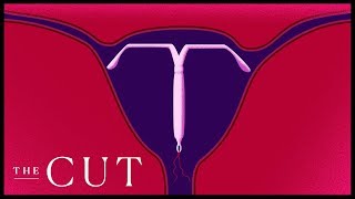 The IUD Is Making a Comeback [upl. by Garreth]