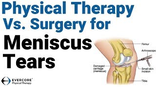 Meniscus Tears Part 2 Physical Therapy vs Surgery for Meniscus Tears  What Should You Do [upl. by Elleryt]