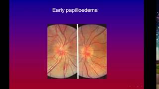 optic nerve and lens Spot diagnosis slides [upl. by Damle49]