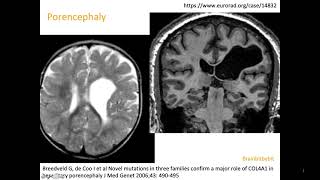 10 Schizencephaly porencephaly COL4A1 mutation congenital CMV open lip closed lip birth defect [upl. by Vola]