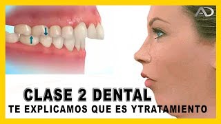 👉Maloclusion dental  𝙈𝙤𝙧𝙙𝙞𝙙𝙖 𝘾𝙡𝙖𝙨𝙚 𝙄𝙄 dental en Ortodoncia  que es y como corregirla [upl. by Odlamur735]