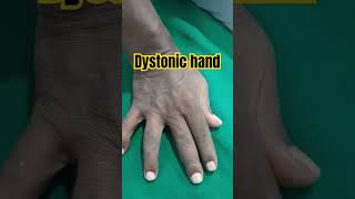 Dystonic hand physiotherapy hospital physicaltherapy psysiocareexercise shorts shortvideo [upl. by Nate]