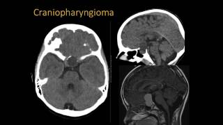 Radiological Characteristics Hypothalamic Hamartomas  Dr Marcia KomlosKukreja [upl. by Leasi]