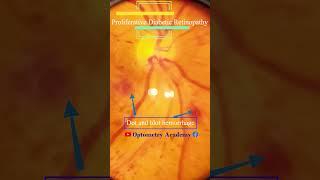 Diabetic retinopathy  Hemorrhages  proliferative diabetic retinopathy PDR  Short Video 177 [upl. by Ateekahs]